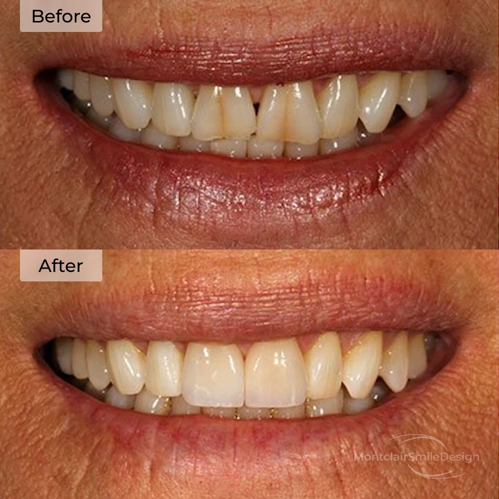 before and after smile makeover at Montclair Smile Design in Oakland, CA
